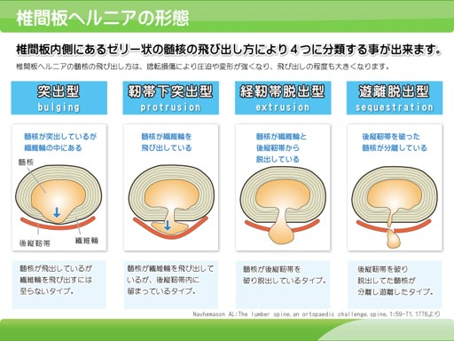 頚椎ヘルニアの症状