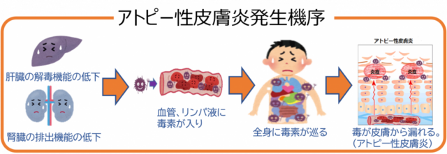 ステロイドを塗ってもアトピー性皮膚炎が治らない あなたへ 四条大宮の鍼灸整体 雑誌掲載あり みわ療法院