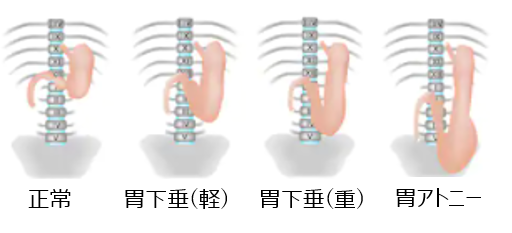 胃下垂の種類