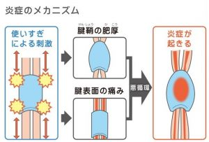 腱鞘炎のメカニズム