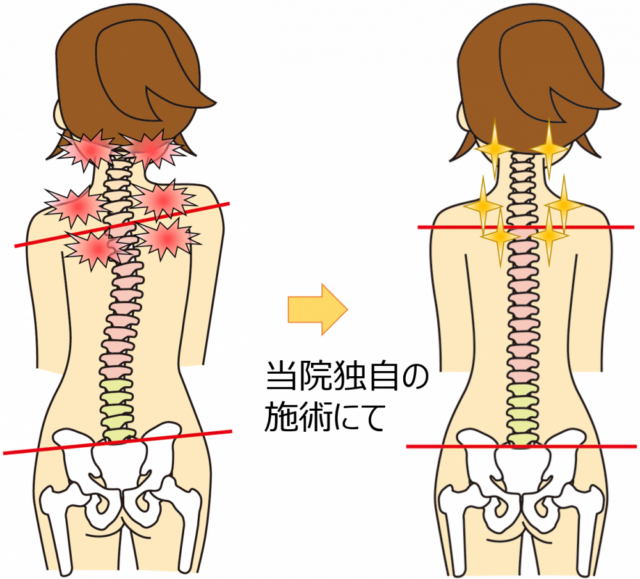 周りの筋肉から頚椎への悪影響