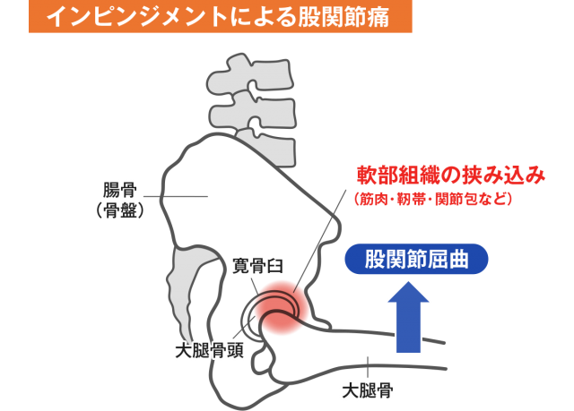 インピンジメントによる股関節痛