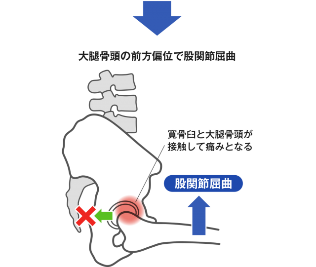 大腿骨頭の前方偏位で股関節屈曲