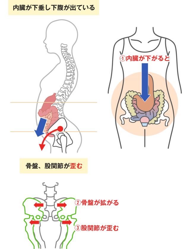 内臓が下垂し下腹が出ている