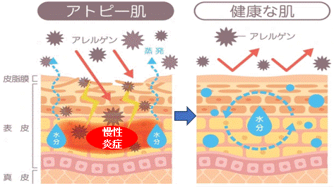 アトピー性皮膚炎の変化