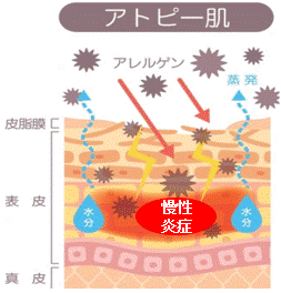 アトピー性皮膚炎の皮膚