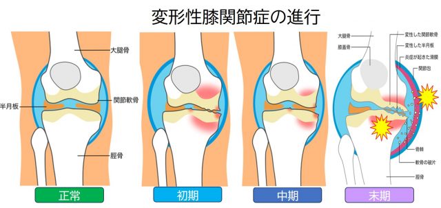 変形性膝関節症の進行