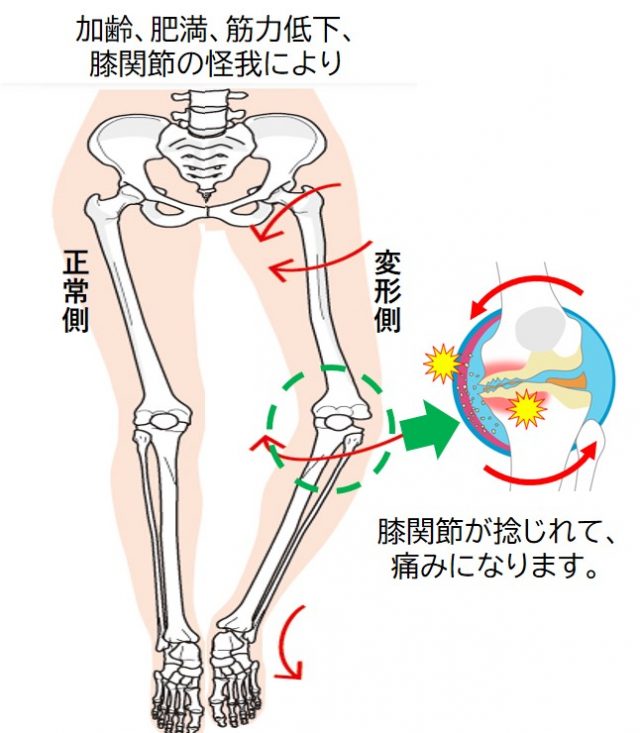 膝関節の捻じれ