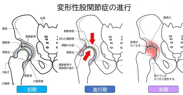 変形性股関節症進行度